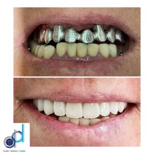 Prima dopo implantologia