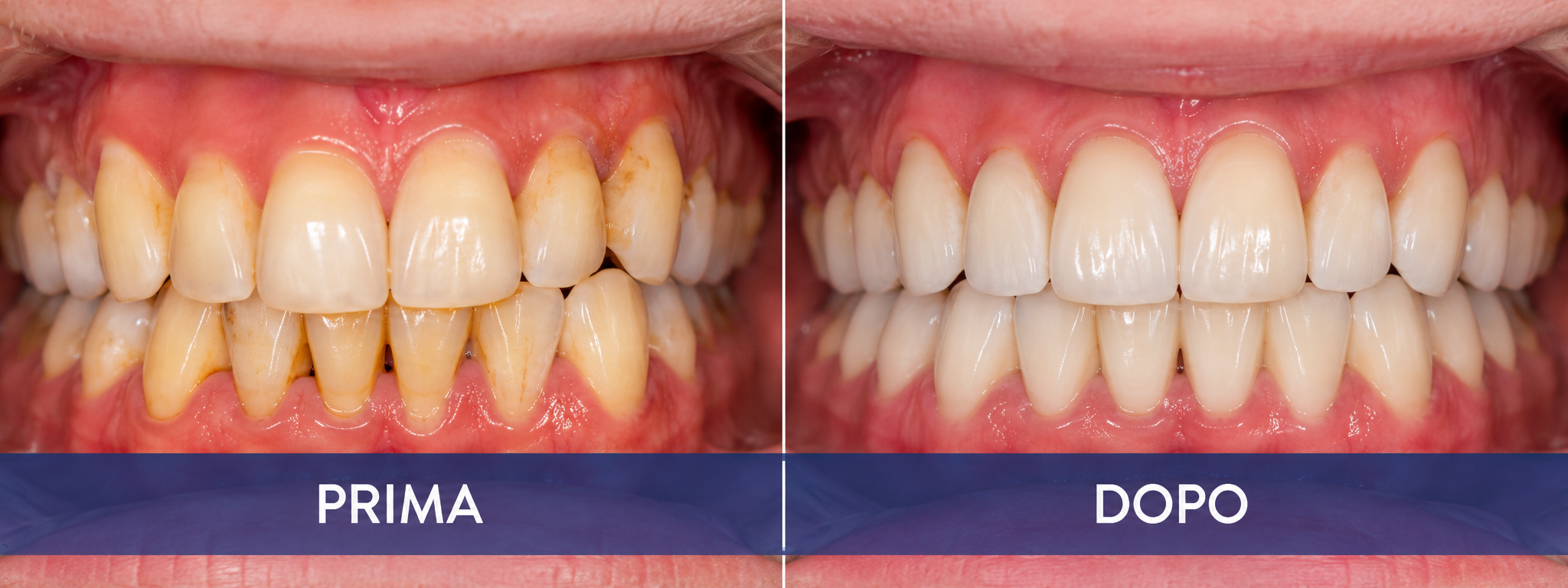 Confronto illustrativo prima e dopo un trattamento di estetica dentale a Pozzuoli.